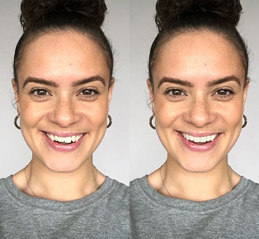 Invisalign case 1