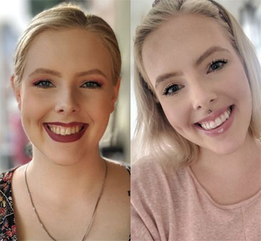 Invisalign case 4