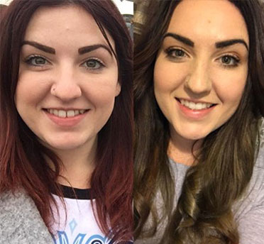 Invisalign case 2