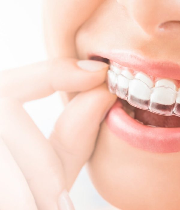 Invisalign