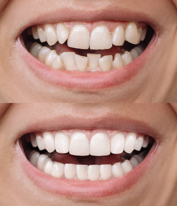 Treatment -  Harcourt Dental Clinic