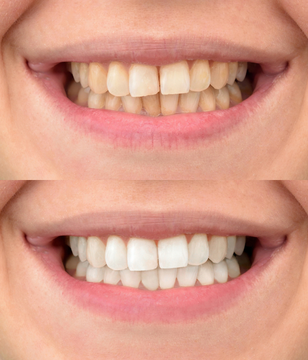 Treatment -  Harcourt Dental Clinic