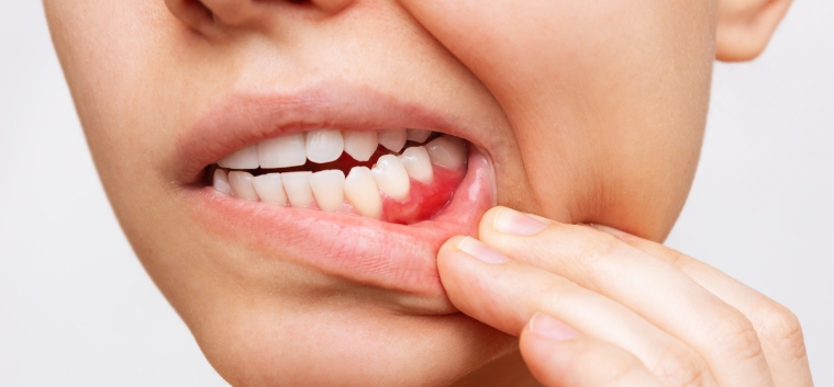 Gum disease