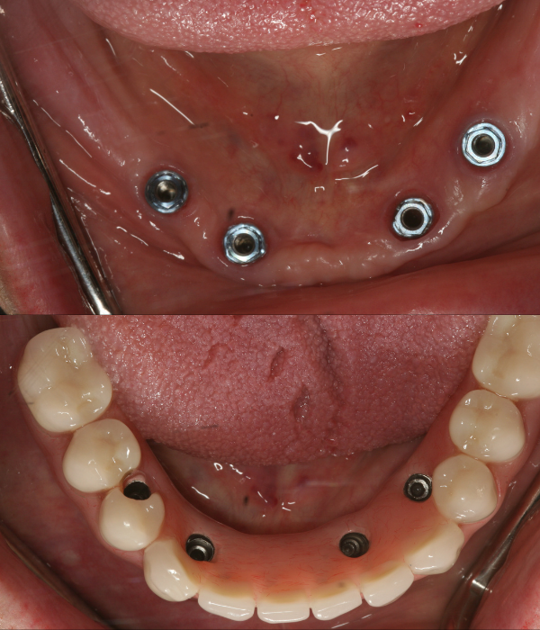 Treatment -  Harcourt Dental Clinic