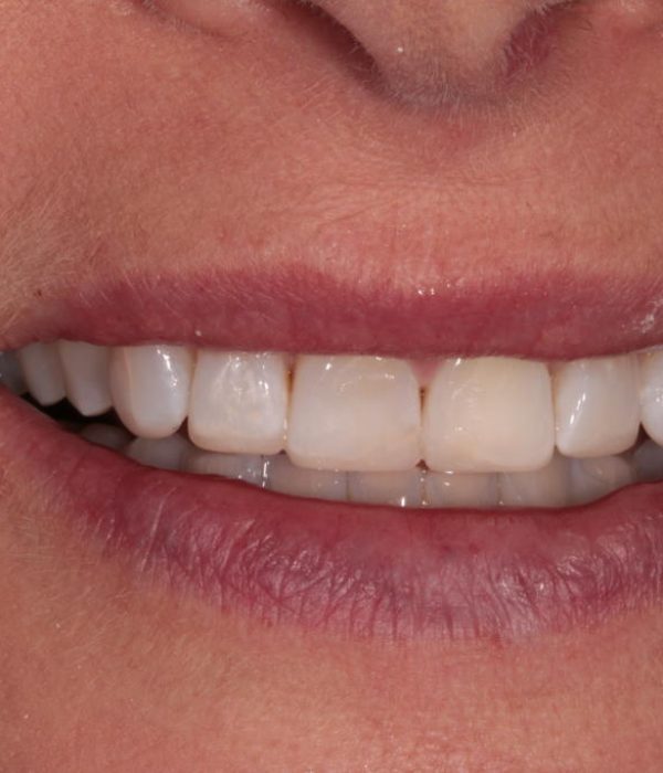 Treatment -  Harcourt Dental Clinic