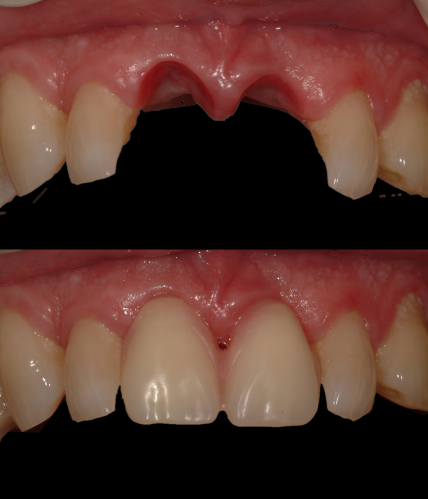 Treatment -  Harcourt Dental Clinic