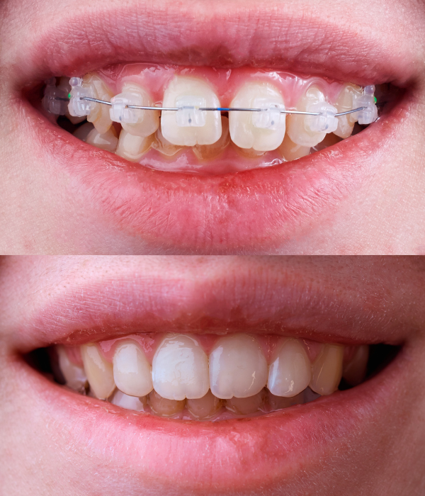 Treatment -  Harcourt Dental Clinic