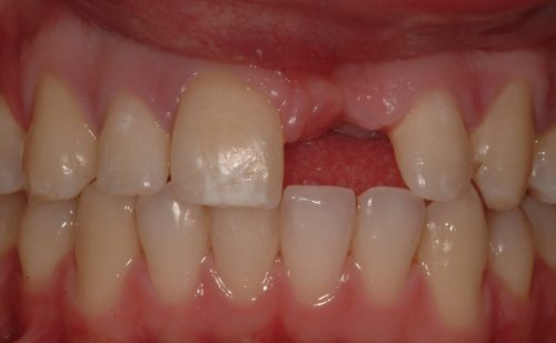 Before - Harcourt Dental Clinic