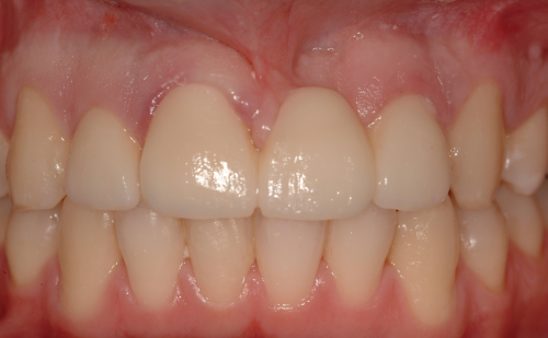 After -Harcourt Dental Clinic