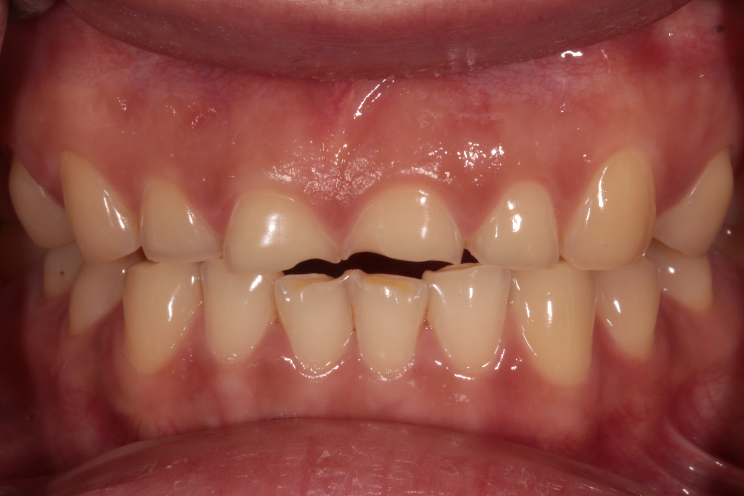 Front teeth showing tooth wear before treatment