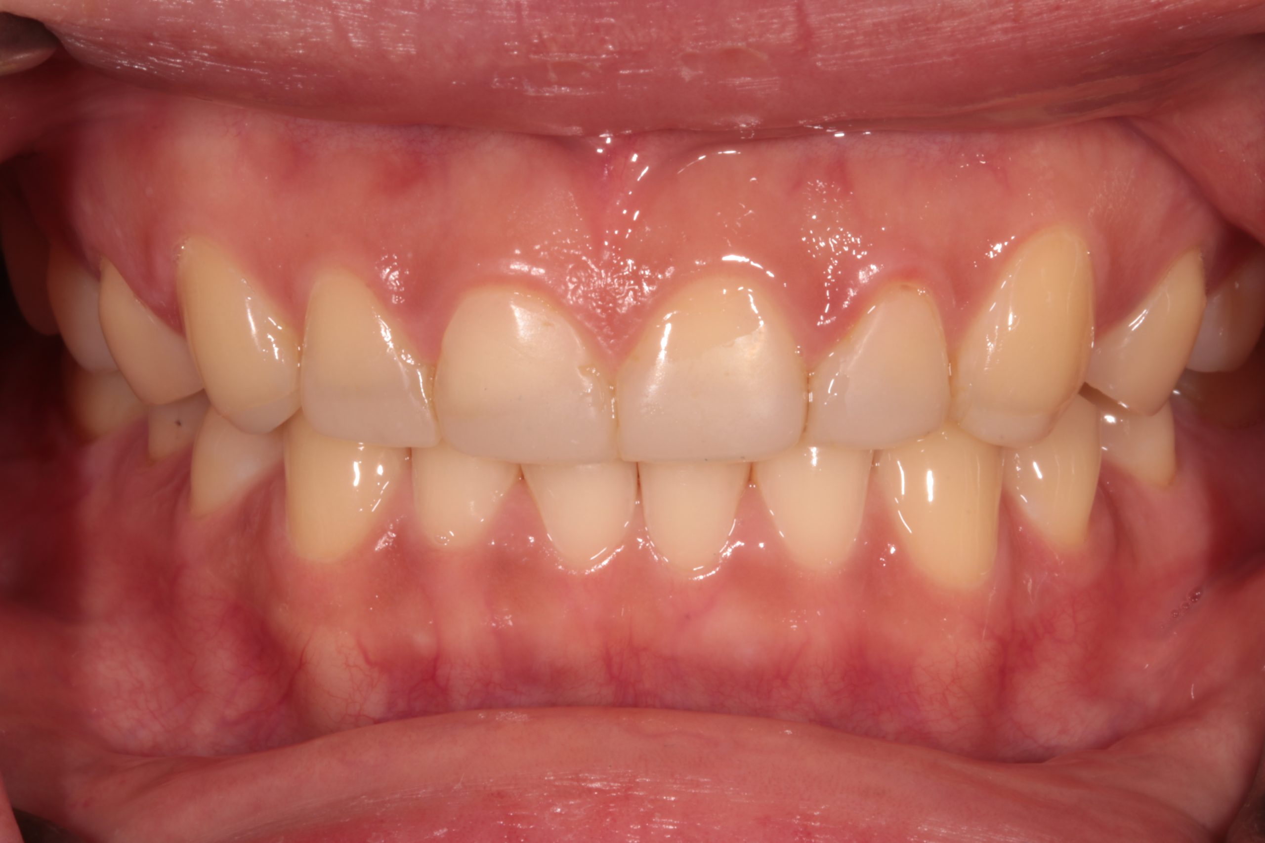 Front teeth after treatment for tooth wear