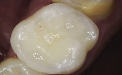 After - Harcourt Dental Clinic