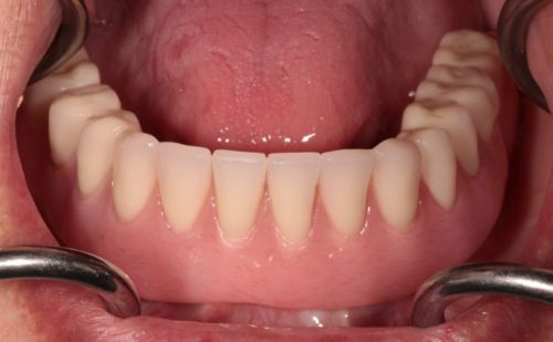 After - Harcourt Dental Clinic