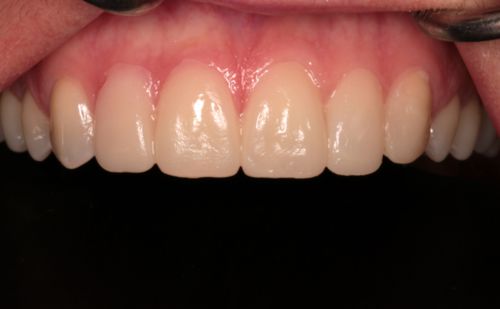 After - Harcourt Dental Clinic
