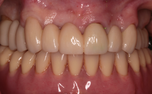 After -Harcourt Dental Clinic