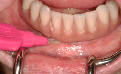 After - Harcourt Dental Clinic