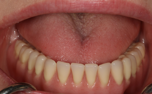 After - Harcourt Dental Clinic