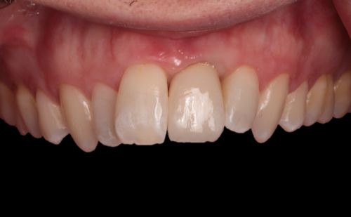 After - Harcourt Dental Clinic