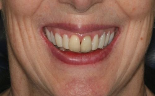 After - Harcourt Dental Clinic