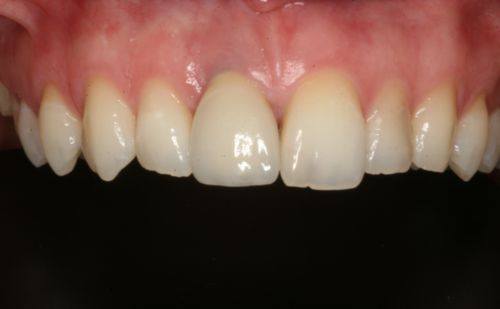 After - Harcourt Dental Clinic