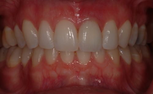 After - Harcourt Dental Clinic