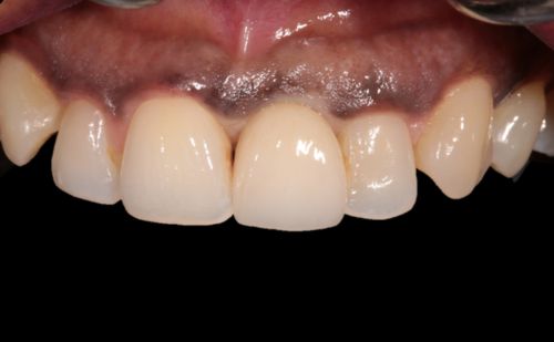 After - Harcourt Dental Clinic