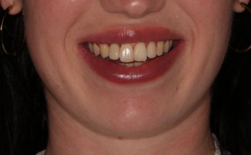 After - Harcourt Dental Clinic