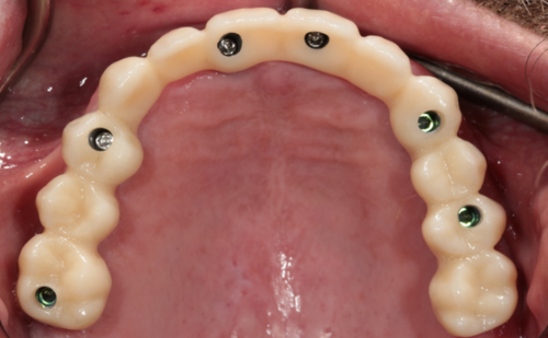 After - Harcourt Dental Clinic