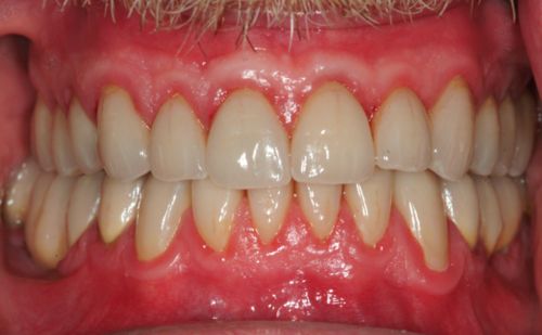 After -Harcourt Dental Clinic