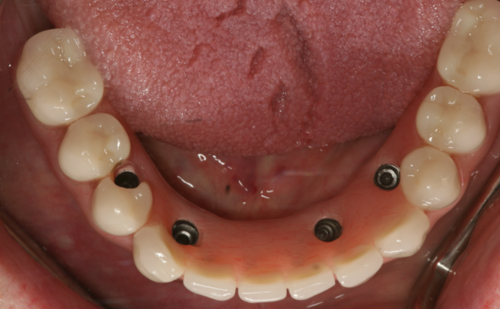 After - Harcourt Dental Clinic