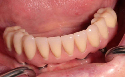 After - Harcourt Dental Clinic