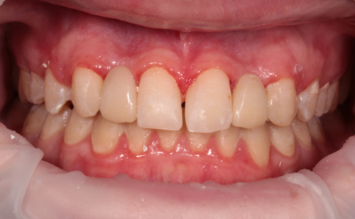 After -Harcourt Dental Clinic