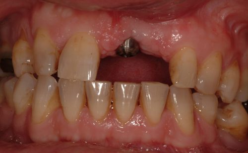 Before - Harcourt Dental Clinic