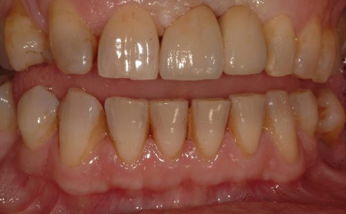 After -Harcourt Dental Clinic