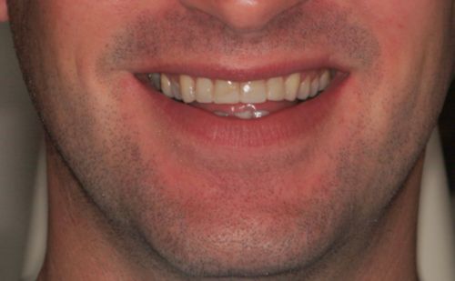 After - Harcourt Dental Clinic